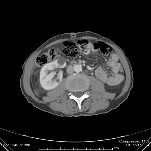Calcified liver metastases (Radiopaedia 44699-48470 B 50).jpg