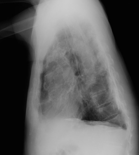 File:Calcified pleural plaques (Radiopaedia 23687-23833 Lateral 1).jpg