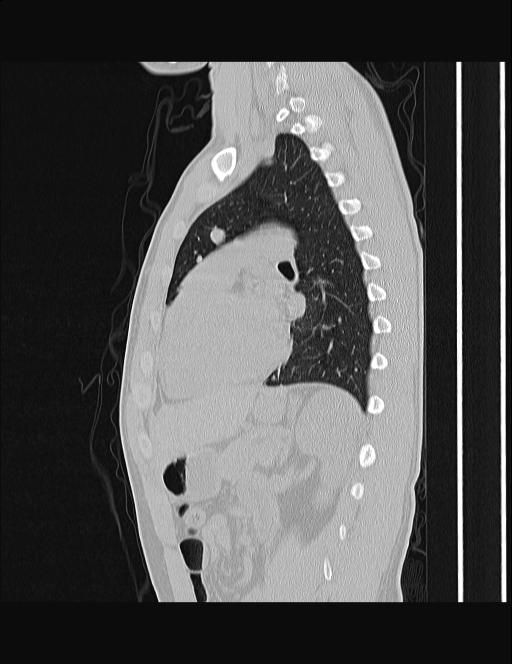 Calcifying pulmonary metastases (Radiopaedia 33359-34396 Sagittal lung window 27).jpg