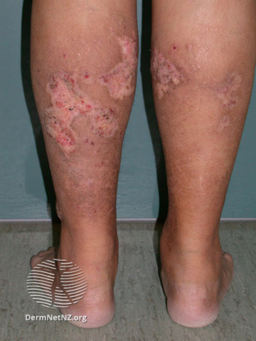 File:Calciphylaxis can lead to- (DermNet NZ systemic-calciphylaxis6).jpg