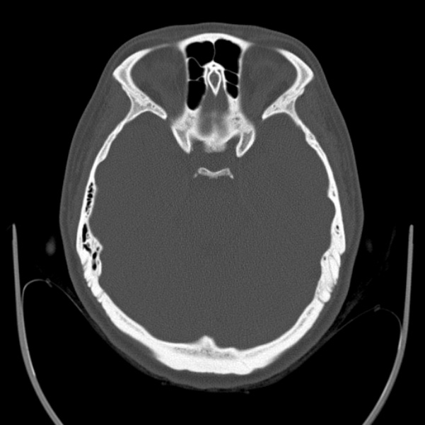 Calvarial osteoma (Radiopaedia 36520-38079 Axial bone window 36).jpg