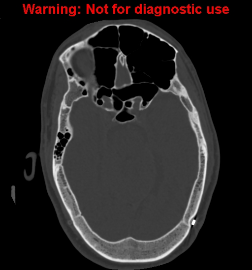 Calvarial thickening from chronic shunting (Radiopaedia 60079-67637 Axial bone window 69).jpg