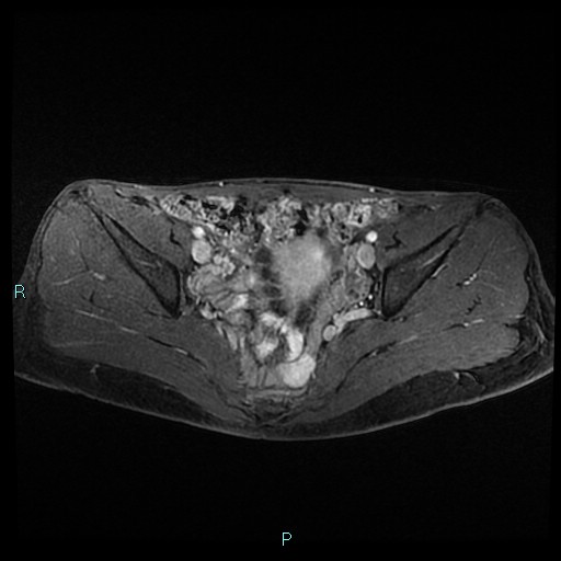 File:Canal of Nuck cyst (Radiopaedia 55074-61448 Axial T1 C+ fat sat 25).jpg