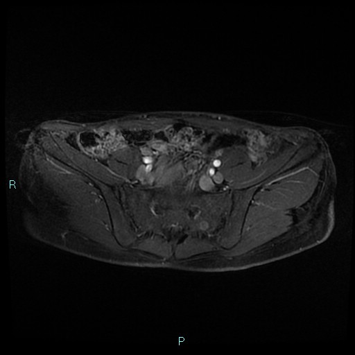 File:Canal of Nuck cyst (Radiopaedia 55074-61448 Axial T1 C+ fat sat 9).jpg
