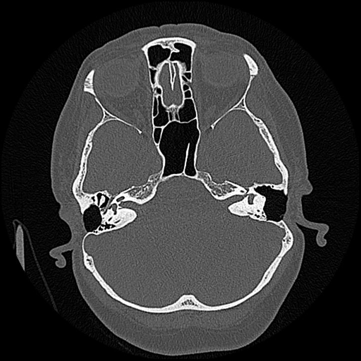 Canal up mastoidectomy (Radiopaedia 78108-90638 Axial bone window 80).jpg