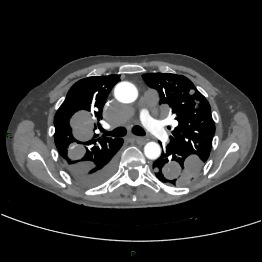 Cannonball metastases (Radiopaedia 82110-96150 Axial C+ CTPA 138).jpg