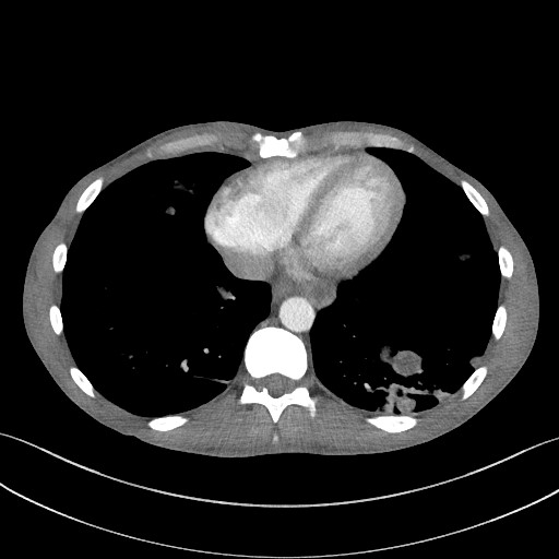 File:Cannonball metastases - testicular choriocarcinoma (Radiopaedia 84510-99891 B 82).jpg