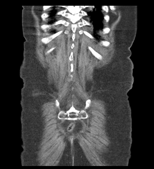 File:Cannonball metastases from endometrial cancer (Radiopaedia 42003-45031 F 56).png