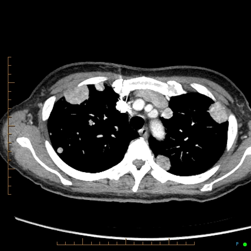 File:Canonball lung metastasis (Radiopaedia 77634-89837 B 21).jpg