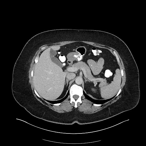 File:Carcinoid tumor - terminal ileum (Radiopaedia 60931-68739 A 37).jpg