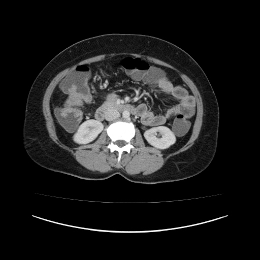 File:Carcinoma colon - hepatic flexure (Radiopaedia 19461-19493 A 58).jpg