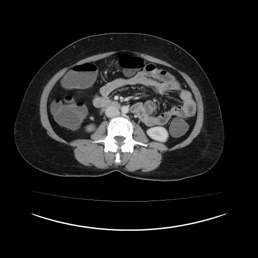 File:Carcinoma colon - hepatic flexure (Radiopaedia 19461-19493 A 64).jpg