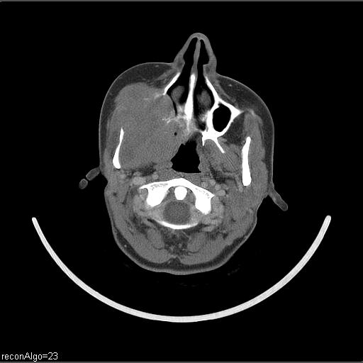 File:Carcinoma of the maxillary antrum (Radiopaedia 53805-59888 Axial C+ delayed 49).jpg