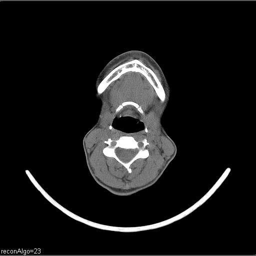 Carcinoma of the maxillary antrum (Radiopaedia 53805-59888 Axial non-contrast 33).jpg