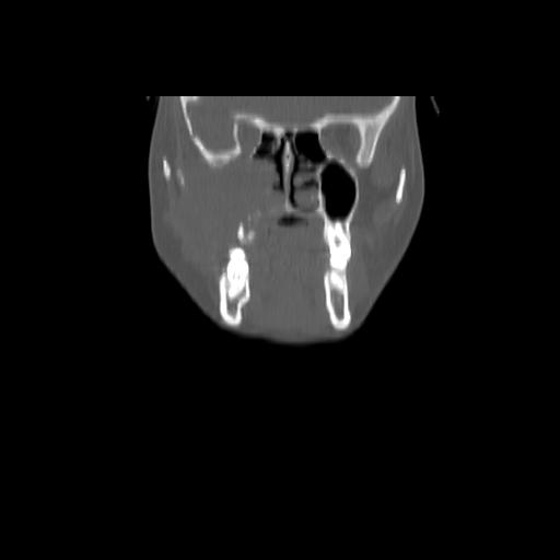 Carcinoma of the maxillary antrum (Radiopaedia 53805-59888 Coronal bone window 45).jpg