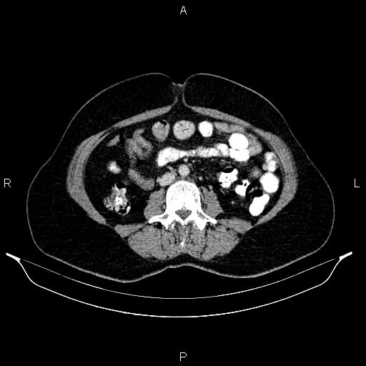 Carcinoma of uterine cervix (Radiopaedia 85861-101700 A 51).jpg
