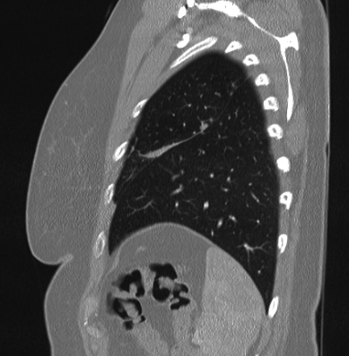 Cardiac sarcoidosis (Radiopaedia 74548-85534 Sagittal lung window 14).jpg