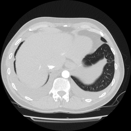 File:Cardiac tamponade (Radiopaedia 78607-91368 Axial lung window 81).jpg