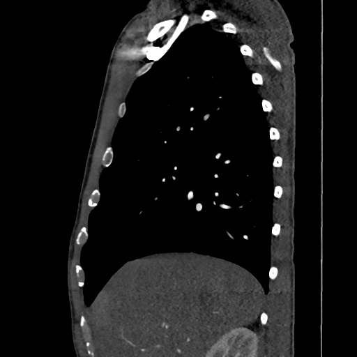 File:Cardiac tumor - undifferentiated pleomorphic sarcoma (Radiopaedia 45844-50134 B 61).png