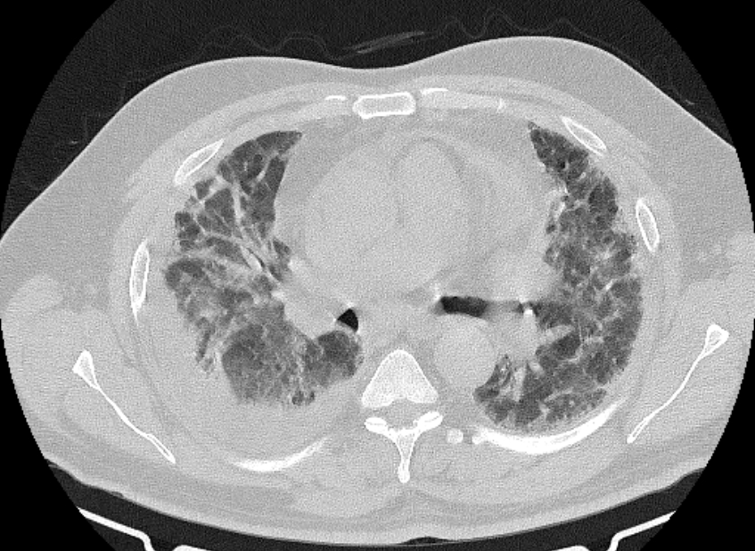 Cardiogenic pulmonary edema (Radiopaedia 68180-77678 Axial lung window 40).jpg