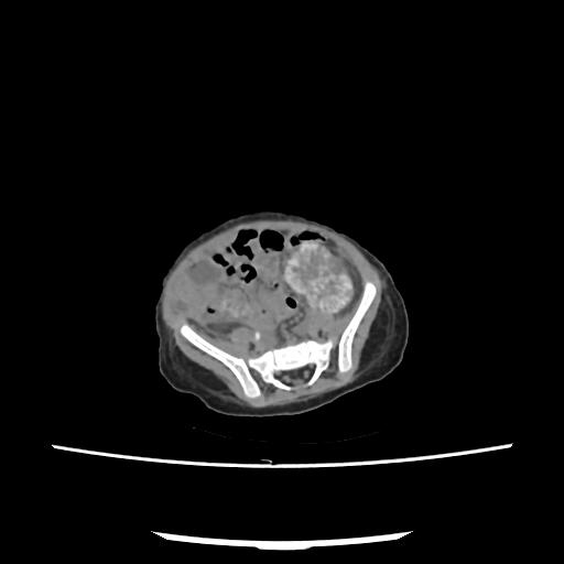 Caroli disease with autosomal recessive polycystic kidney disease (ARPKD) (Radiopaedia 89651-106703 E 183).jpg