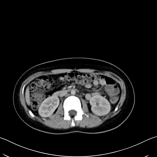 Caroli disease with medullary sponge kidney (Radiopaedia 82622-96804 C 32).jpg