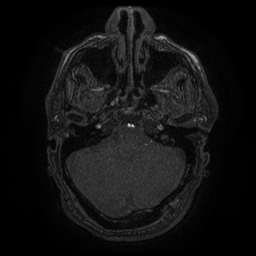 Carotid arterial dissection with acute cerebral infarction (Radiopaedia 26636-26784 MRA 140).jpg