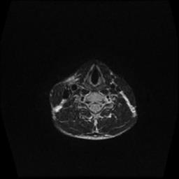 File:Carotid body tumor (Radiopaedia 30208-30823 Axial T2 4).jpg