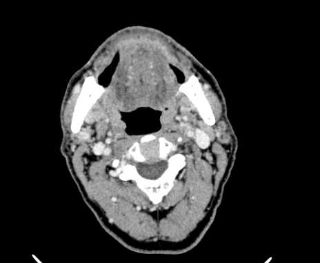 Carotid body tumor (Radiopaedia 61750-69757 Axial Post contrast 33).jpg