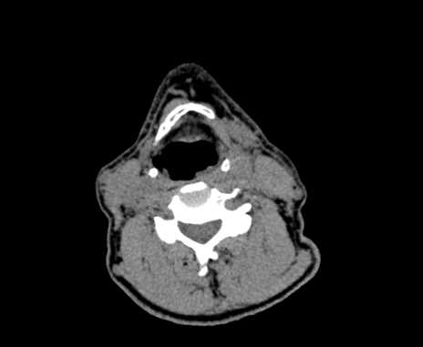 Carotid body tumor (Radiopaedia 61750-69757 Axial non-contrast 61).jpg