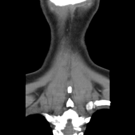 File:Carotid body tumor (paraganglioma) (Radiopaedia 38586-40729 B 39).jpg