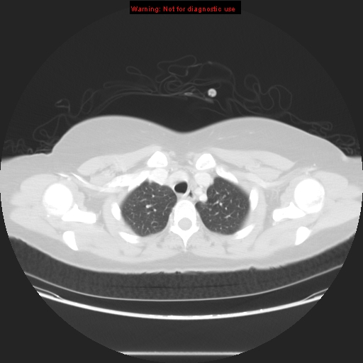 File:Carotid body tumor with lung metastases (Radiopaedia 9301-48390 Axial lung window 17).jpg