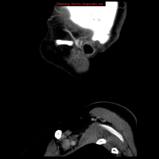 Carotid body tumor with lung metastases (Radiopaedia 9301-9986 Sagittal C+ delayed 1).jpg