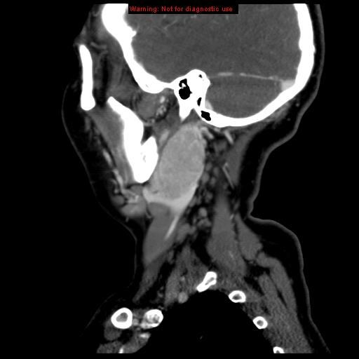 Carotid body tumor with lung metastases (Radiopaedia 9301-9986 Sagittal C+ delayed 42).jpg