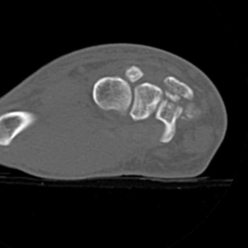 File:Carpo-metacarpal fracture-dislocations with hamatum split fracture (Radiopaedia 18482-18343 Axial bone window 17).jpg