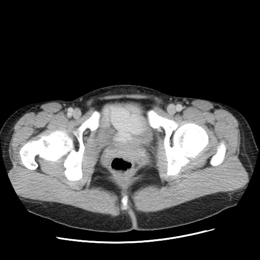 Castleman disease with fibrous pseudotumor in the abdomen (Radiopaedia 77296-89373 A 125).jpg