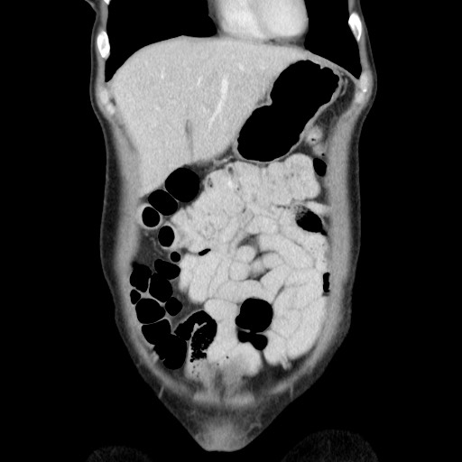 Castleman disease with fibrous pseudotumor in the abdomen (Radiopaedia 77296-89373 B 22).jpg