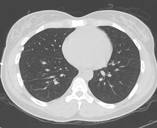 File:Catamenial pneumothorax (Radiopaedia 54382-60600 Axial 34).png