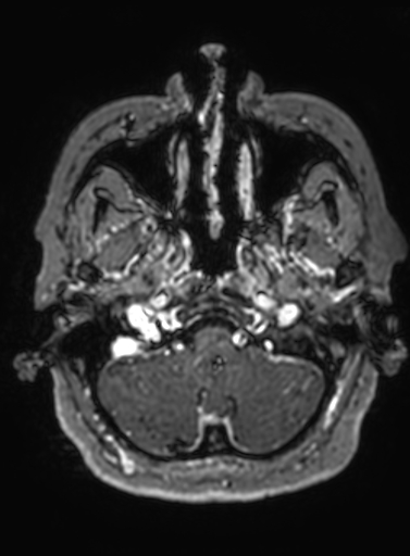 Cavernous hemangioma of the cerebellar falx (Radiopaedia 73025-83724 Axial T1 C+ 295).jpg