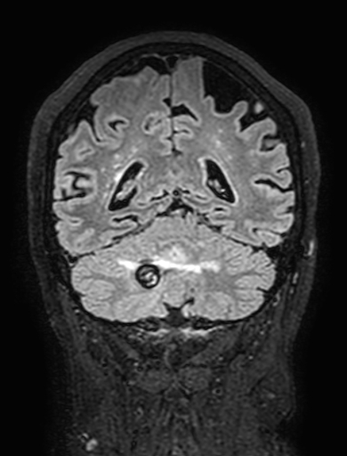 Cavernous hemangioma of the cerebellar falx (Radiopaedia 73025-83724 Coronal FLAIR 253).jpg