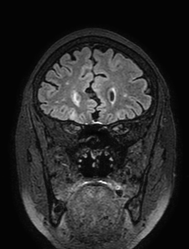Cavernous hemangioma of the cerebellar falx (Radiopaedia 73025-83724 Coronal FLAIR 89).jpg