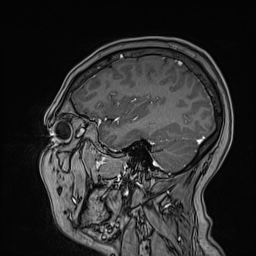 Cavernous sinus meningioma (Radiopaedia 63682-72367 Sagittal T1 C+ 127).jpg