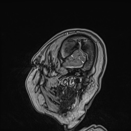 Cavernous sinus meningioma (Radiopaedia 63682-72367 Sagittal T1 C+ 30).jpg