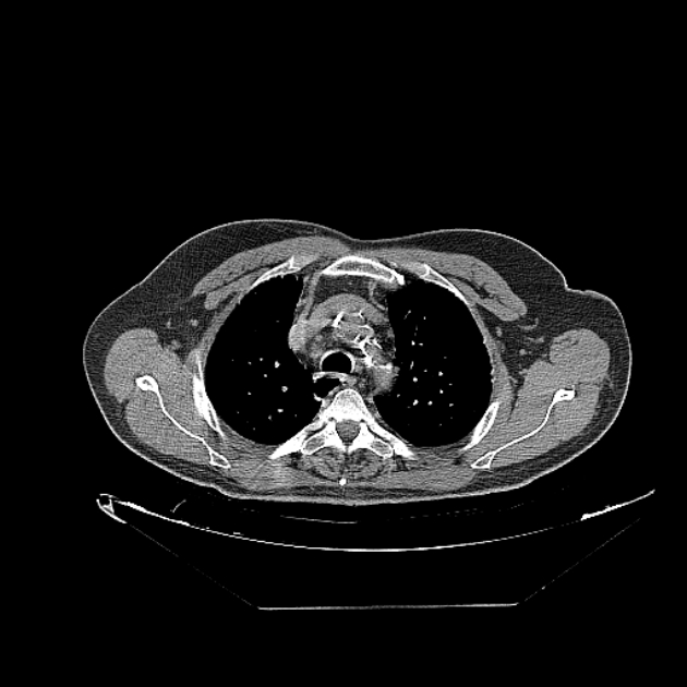 Cavitating bronchogenic carcinoma (Radiopaedia 44489-48162 Axial non-contrast 16).jpg