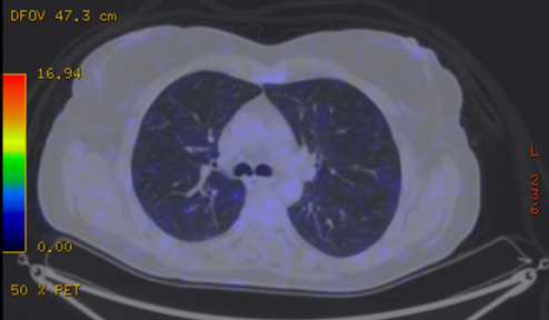 File:Cavitating lung mass - squamous cell carcinoma (Radiopaedia 48047-52853 A 39).png