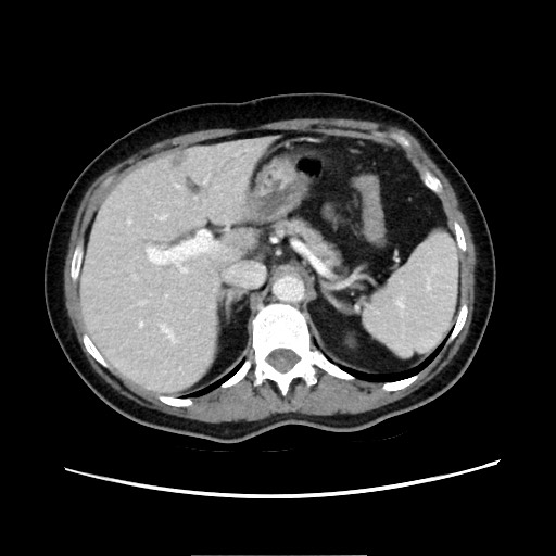 Cecal adenocarcinoma (Radiopaedia 75909-87331 A 27).jpg