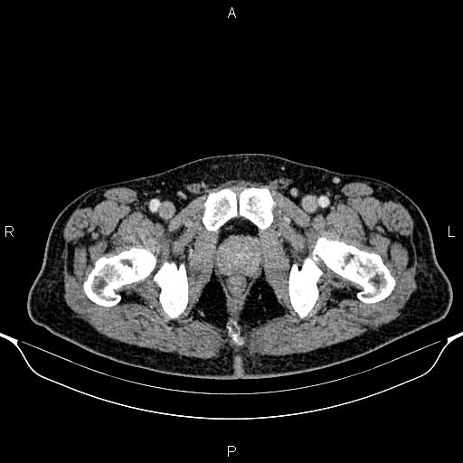 Cecal adenocarcinoma (Radiopaedia 85324-100916 B 101).jpg