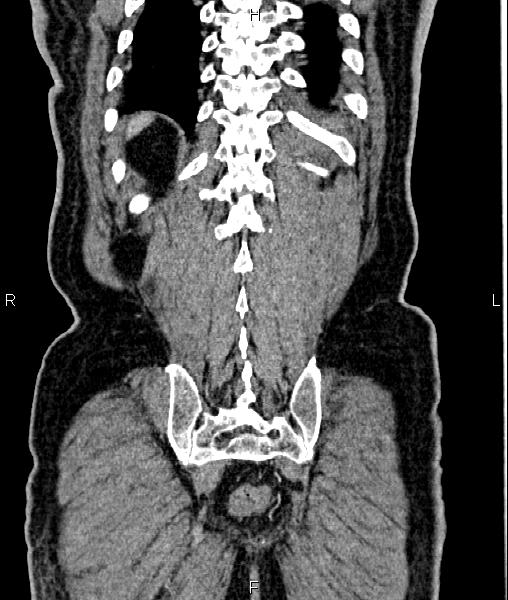 Cecal cancer with appendiceal mucocele (Radiopaedia 91080-108651 D 64).jpg
