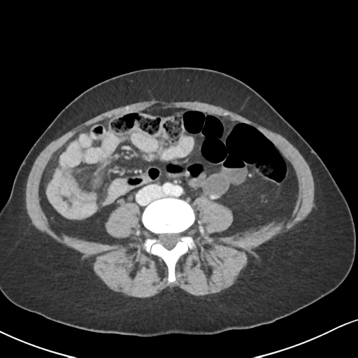 Cecal internal hernia through the foramen of Winslow (Radiopaedia 44820-48651 B 45).png