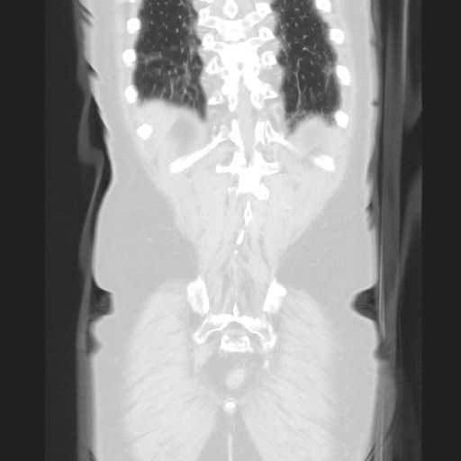 Cecal volvulus (Radiopaedia 75378-86620 Coronal lung window 116).jpg
